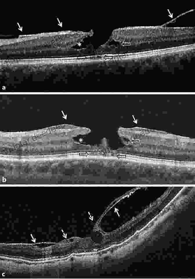 Detailed Ultrasound Images And Descriptions Of Vitreous Detachment, Macular Holes, And Epiretinal Membranes Clinical Atlas Of Ophthalmic Ultrasound