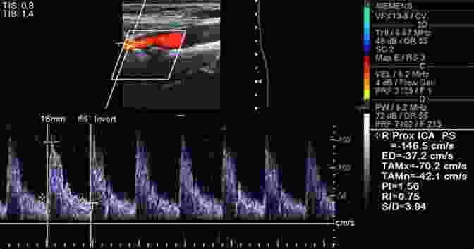 Doppler Ultrasound Images Of Ocular Blood Flow In Carotid And Ophthalmic Arteries Clinical Atlas Of Ophthalmic Ultrasound