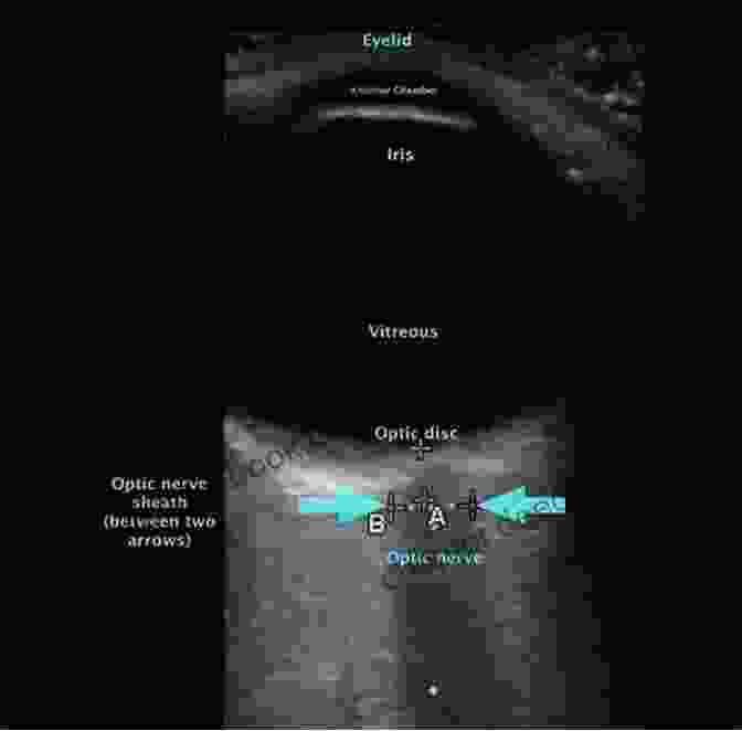 Ultrasound Measurement Of Optic Nerve Head And Anterior Chamber Angles Clinical Atlas Of Ophthalmic Ultrasound